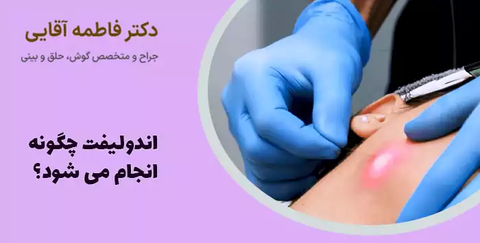 اندولیفت چگونه انجام می شود؟