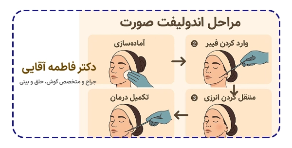 مراحل اندولیفت صورت