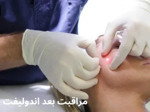 مراقبتهای بعد از اندولیفت