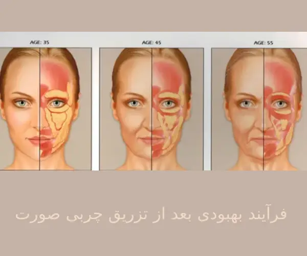 فرآیند بهبودی بعد از تزریق چربی صورت