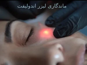 ماندگاری لیزر اندولیفت