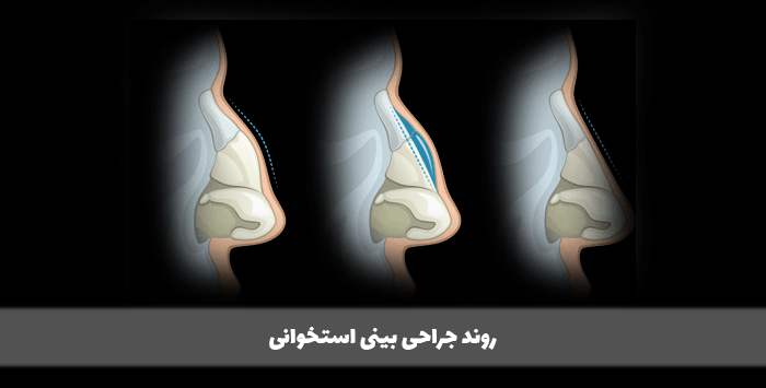 روند جراحی بینی استخوانی