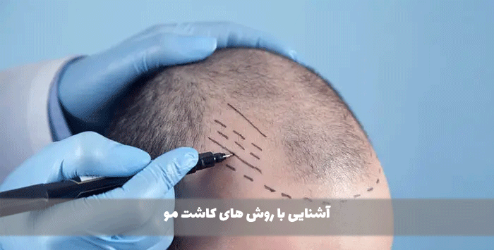 آشنایی با روش های کاشت مو