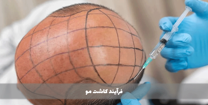 فرآیند کاشت مو