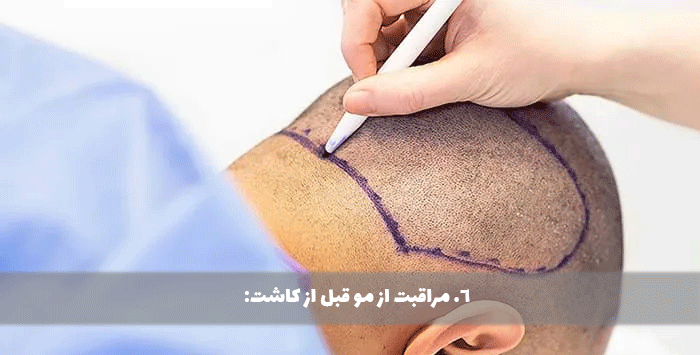 6. مراقبت از مو قبل از کاشت:
