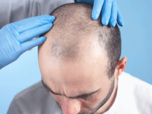 مراقبت های قبل کاشت مو