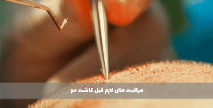 مراقبت های لازم قبل کاشت مو