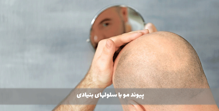 پیوند مو با سلولهای بنیادی