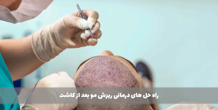 راه حل های درمانی ریزش مو بعد از کاشت