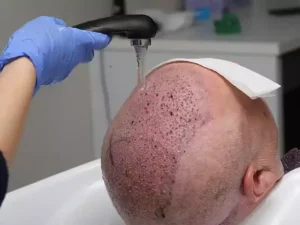 شستن سر بعد از کاشت مو