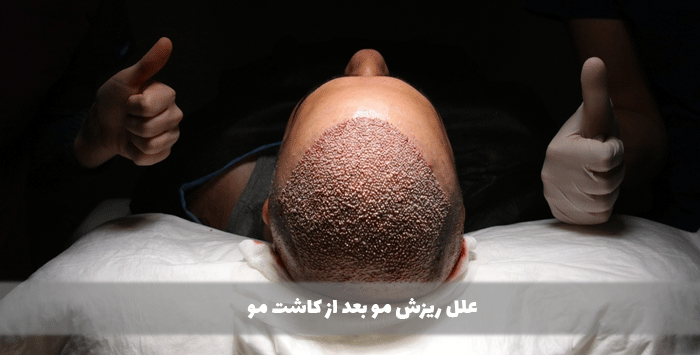 علل ریزش مو بعد از کاشت مو