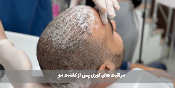 مراقبت های فوری پس از کاشت مو