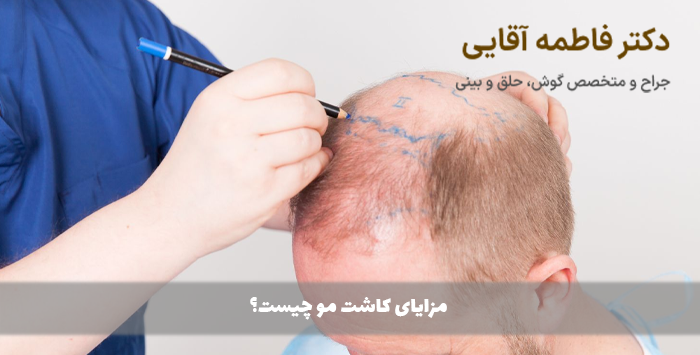 مزایای کاشت مو چیست؟