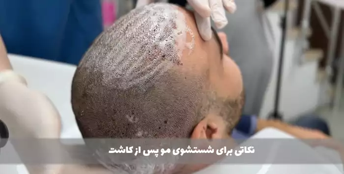 نکاتی برای شستشوی مو پس از کاشت