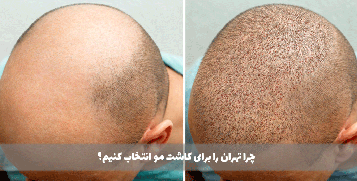 چرا تهران را برای کاشت مو انتخاب کنیم؟