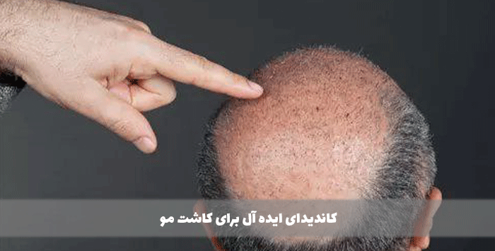 کاندیدای ایده آل برای کاشت مو