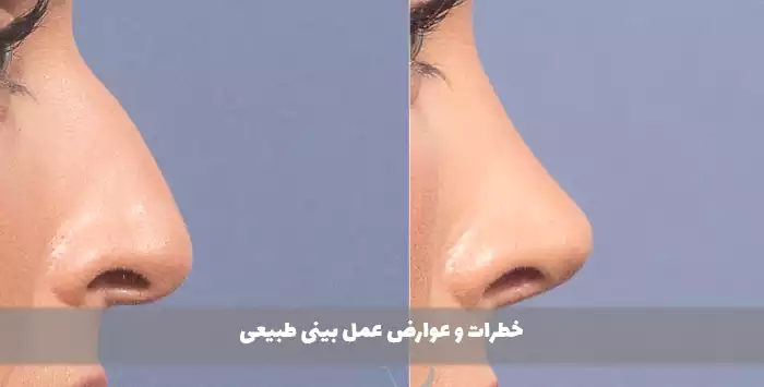 خطرات و عوارض عمل بینی طبیعی