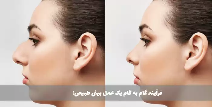 فرآیند گام به گام یک عمل بینی طبیعی: