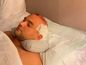 نحوه خوابیدن بعد از کاشت مو