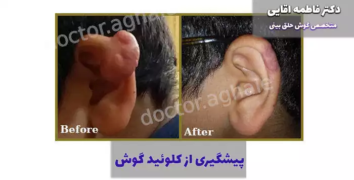 پیشگیری از کلوئید گوش