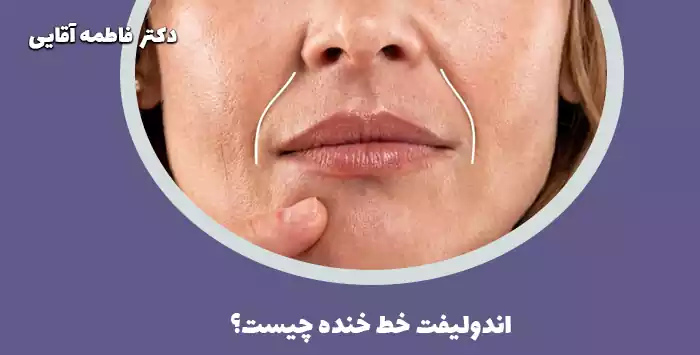 اندولیفت خط خنده چیست؟