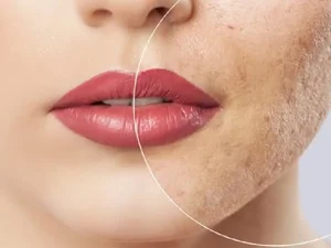 اندولیفت جای جوش