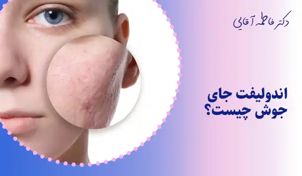 اندولیفت جای جوش چیست؟