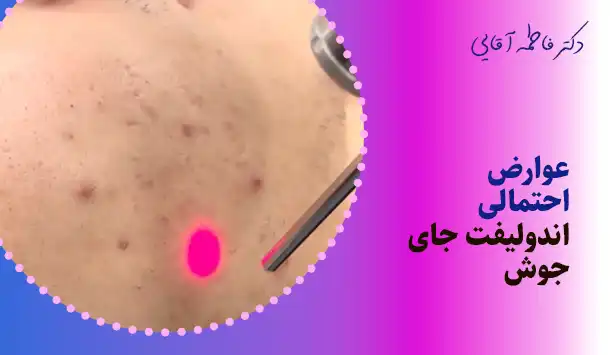 عوارض احتمالی اندولیفت جای جوش