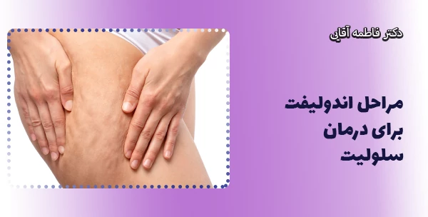 مراحل اندولیفت برای درمان سلولیت