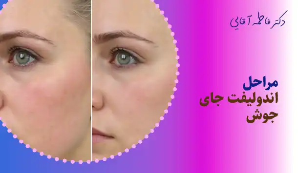 مراحل اندولیفت جای جوش