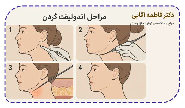 مراحل اندولیفت گردن مراحل اندولیفت گردن