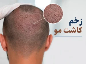 زخم کاشت مو