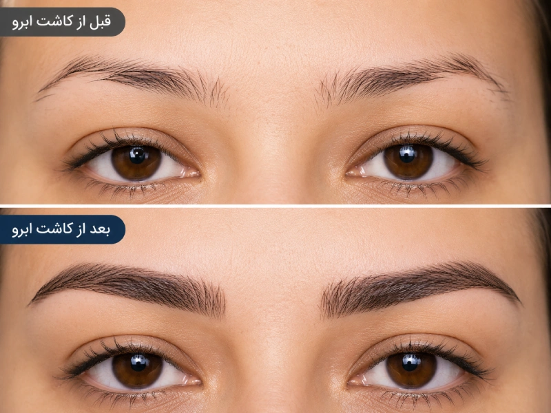 قبل و بعد کاشت ابرو