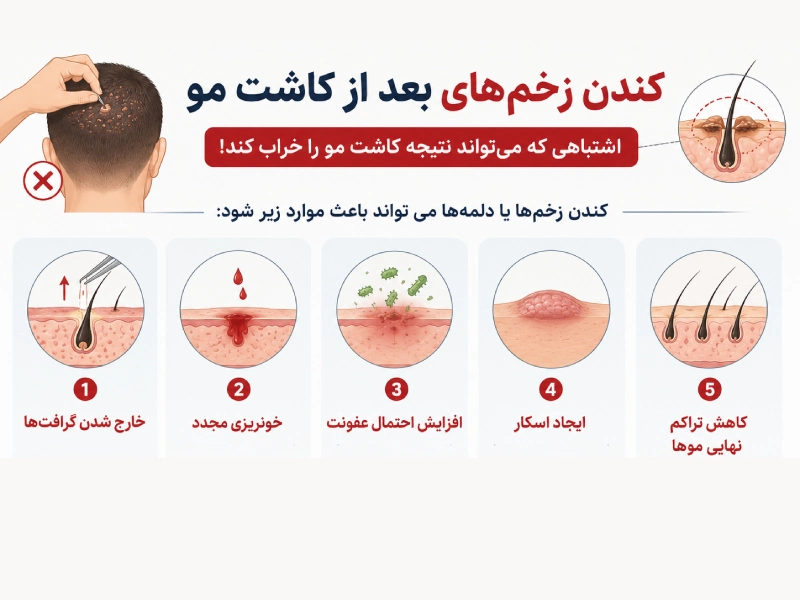 کندن زخم کاشت مو